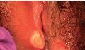 Lipschutz ulcer (loét sinh dục cấp tính)